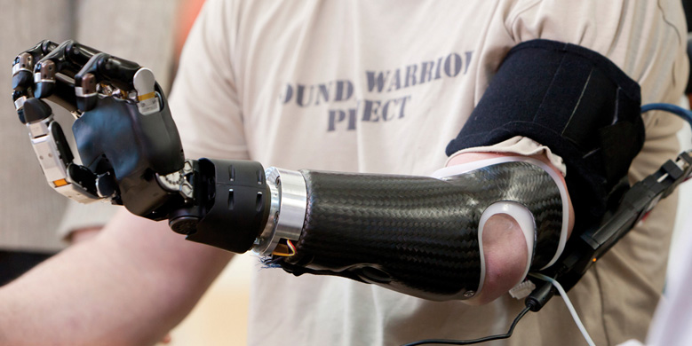 Weight Makes Prosthetics Cases Difficult (Times Free Press)