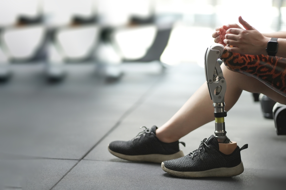 Prosthetic Leg Solutions in Fort Myers
