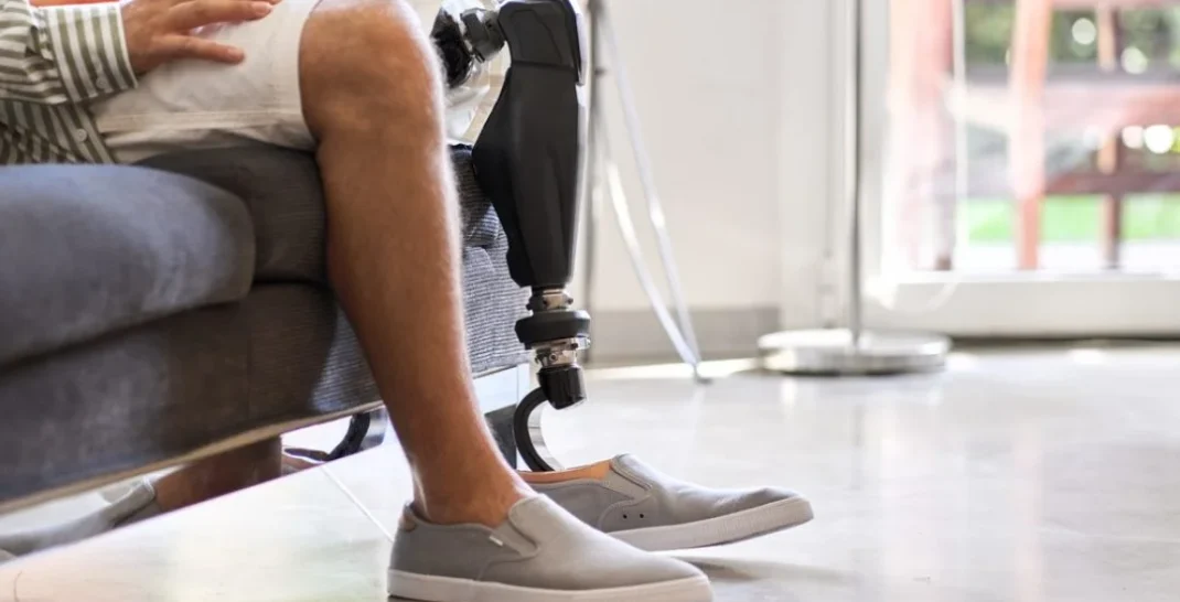 What Are The Steps in Being Fitted For a Prosthetic Device